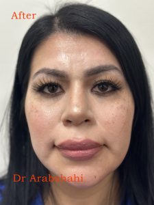 Before and After from Wade 2