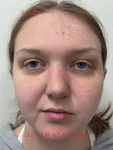 Abigail Pre and Post F