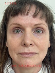 Clark Pre and Post 7