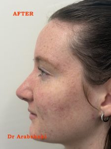 After Rhinoplasty