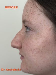 Before Rhinoplasty