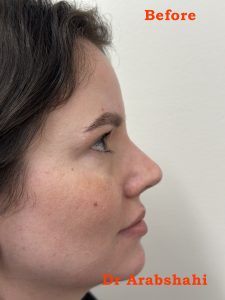 Nova Rhinoplasty Before