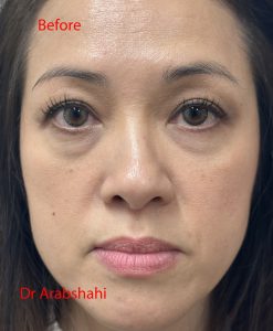 Before & After Rhinoplasty 143 125