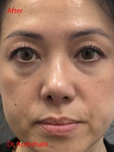 Before & After Rhinoplasty 144 126