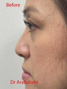 Before & After Rhinoplasty 145 127