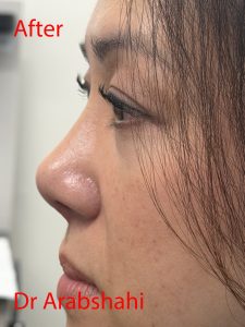 Before & After Rhinoplasty 146 128