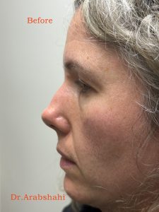 Before & After Rhinoplasty 147 129