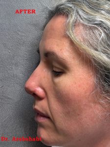 Before & After Rhinoplasty 148 130