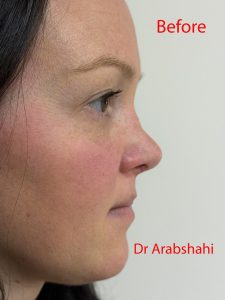 Before & After Rhinoplasty 149 131