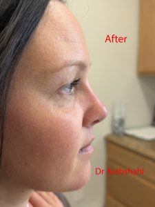 Before & After Rhinoplasty 150 132